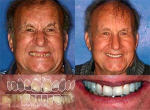 Dental Implants Maple